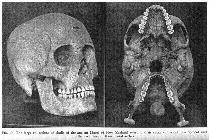 Schädel eines prähistorischen Maoris in Neuseeland. Bild 73 aus "Nutrition and Physical Degeneration" von Dr. Weston A. Price.